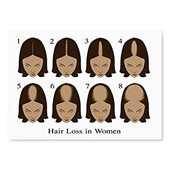 【中古】【輸入品・未使用】Posterazzi Hair Loss ポスタープリント Gwen Shockey/Science Source(24 x 18)、各種｜スカイマーケットプラス