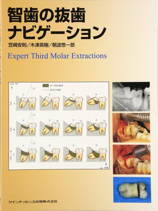 【中古】智歯の抜歯ナビゲ-ション