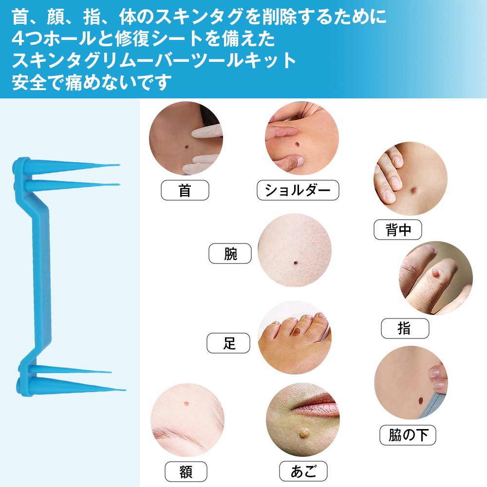 市場 イボ除去 スキンタグ除去ツールキット イボケア イボ スキンタグ除去デバイスキット スキンタグ イボ取り